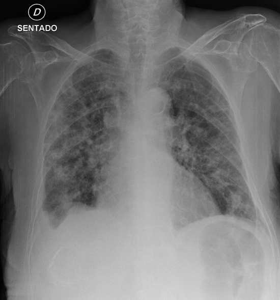 COVID-19 Diagnosis